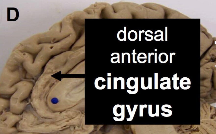 dorsal anterior cingulate gyrus